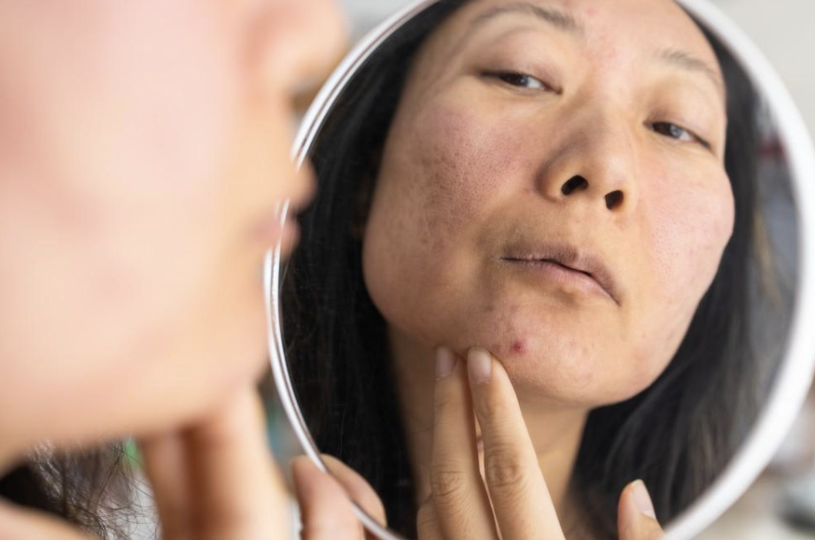 Dermatologist Quincy, MA: Understanding Acne