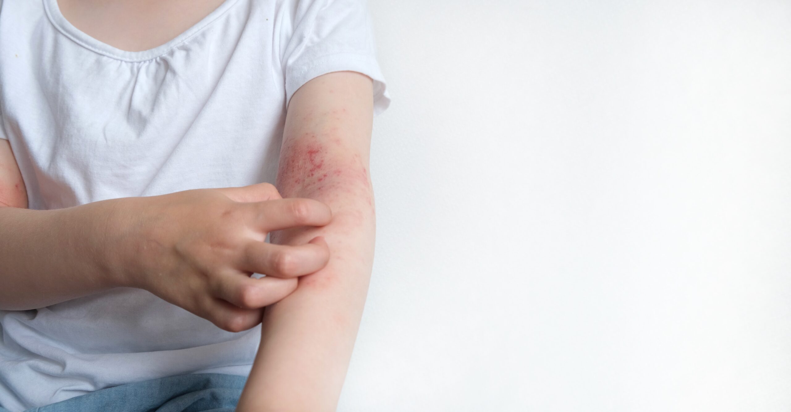 Quincy Dermatologist: Key Eczema Triggers and Solutions You Need to Know